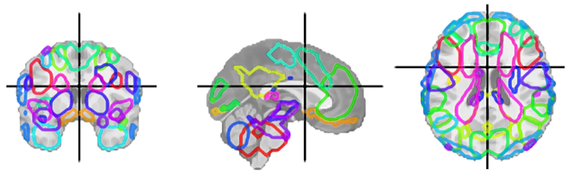 Unraveling the Brain Dynamics of Depersonalization-Derealization Disorder: A Dynamic Functional Network Connectivity Analysis