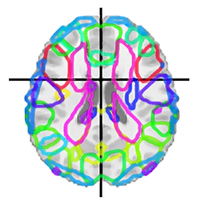 Unraveling the Brain Dynamics of Depersonalization-Derealization Disorder: A Dynamic Functional Network Connectivity Analysis
