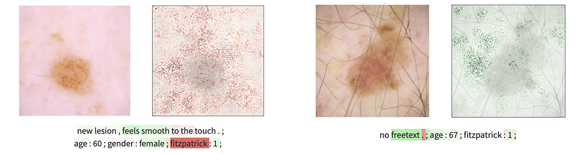 Multimodal Models for Skin Cancer Classification using Clinical Free Text and Dermatoscopic Images