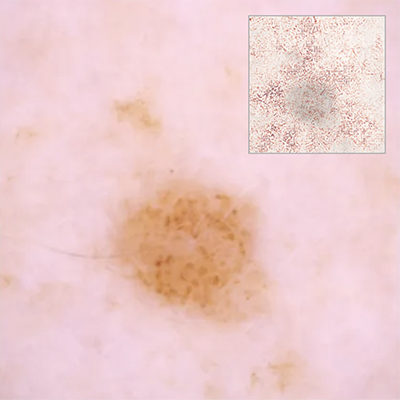 Multimodal Models for Skin Cancer Classification using Clinical Free Text and Dermatoscopic Images